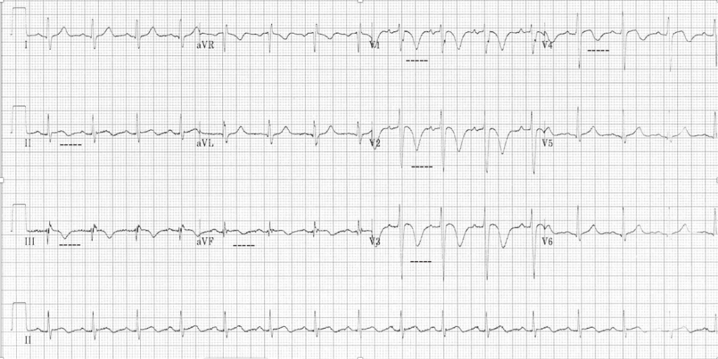 EMERGENCY MEDICAL SERVICES-ECG JUNE EDITION - Emergency Medical ...