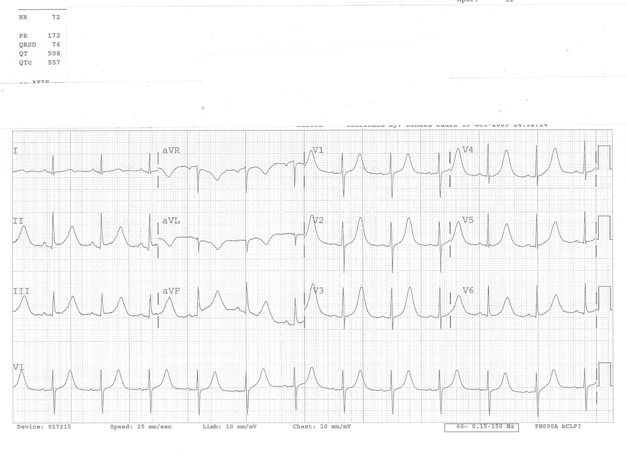 ECG