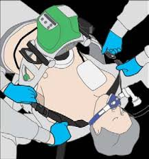 Imagen del Servicio Médico de Emergencia del Condado de Tuolomne: https://www.tuolumnecounty.ca.gov/DocumentCenter/View/8464/S11-Chest-Compression-Systems