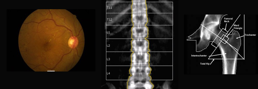 retinal and bone density